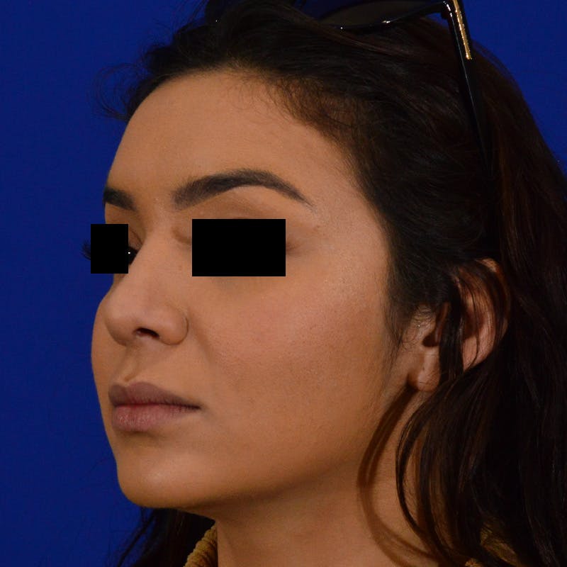 Female Rhinoplasty Before & After Gallery - Patient 168003 - Image 10