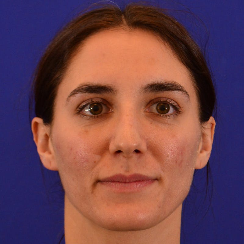 Female Rhinoplasty Before & After Gallery - Patient 414868 - Image 3