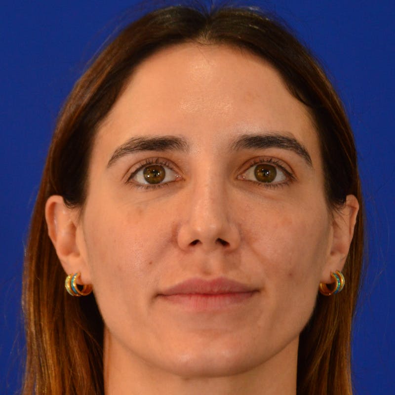 Female Rhinoplasty Before & After Gallery - Patient 414868 - Image 4