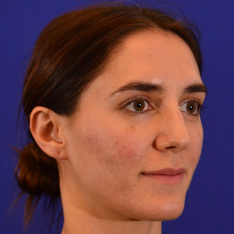 Female Rhinoplasty Before & After Gallery - Patient 414868 - Image 5