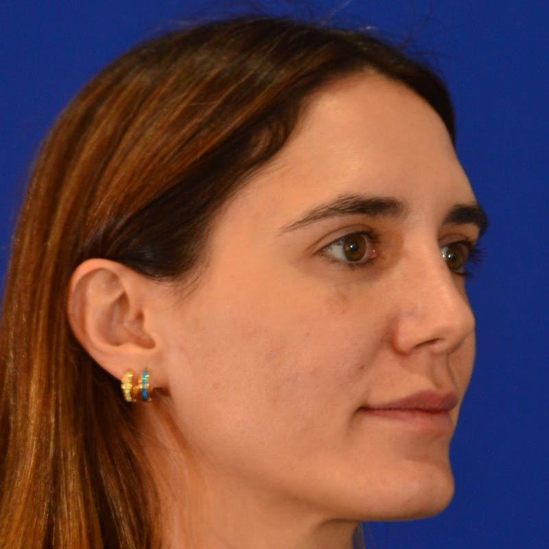 Female Rhinoplasty Before & After Gallery - Patient 414868 - Image 6