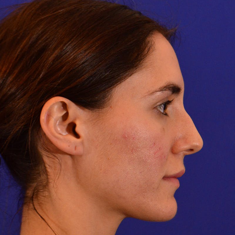 Female Rhinoplasty Before & After Gallery - Patient 414868 - Image 7