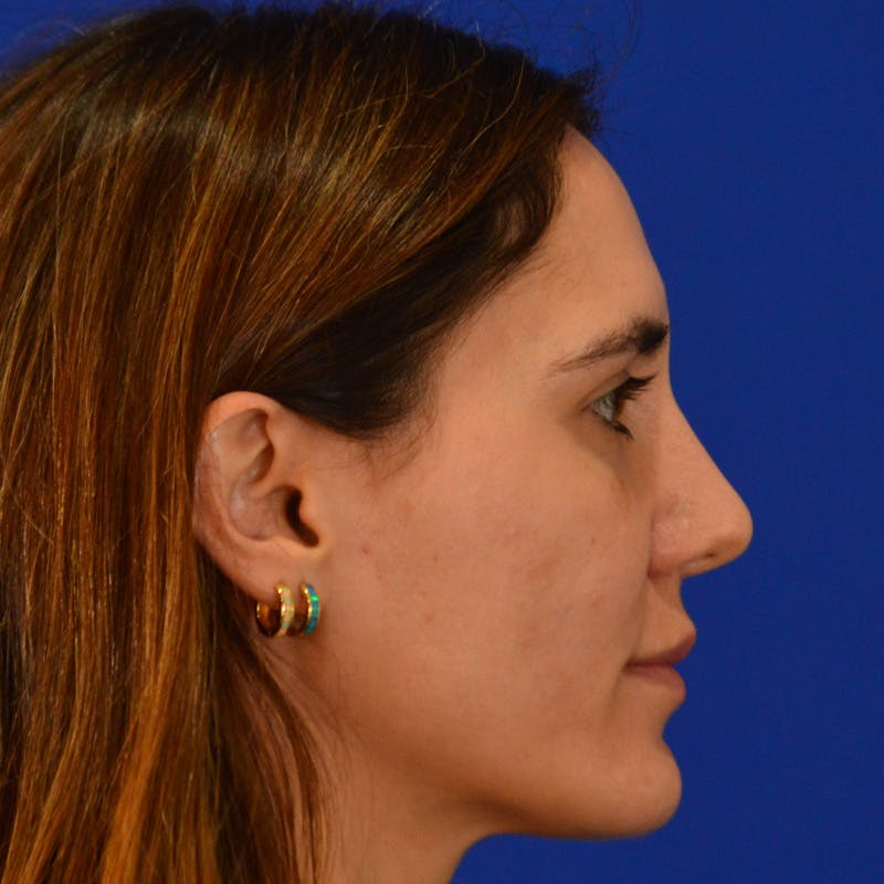 Female Rhinoplasty Before & After Gallery - Patient 414868 - Image 8