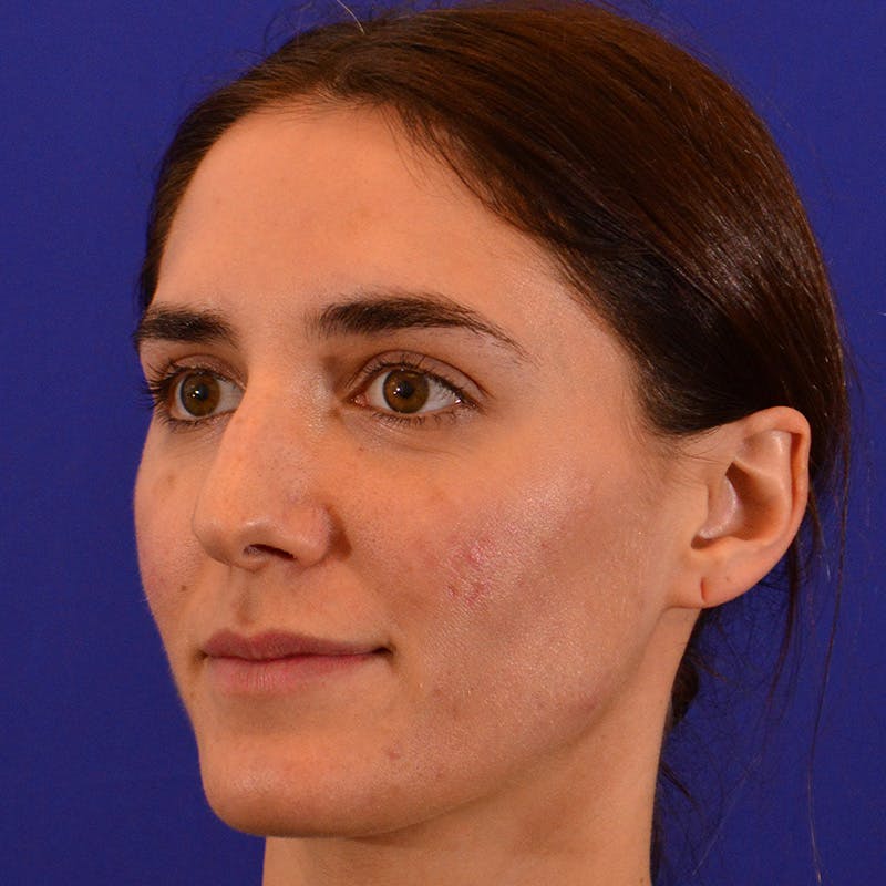 Female Rhinoplasty Before & After Gallery - Patient 414868 - Image 9