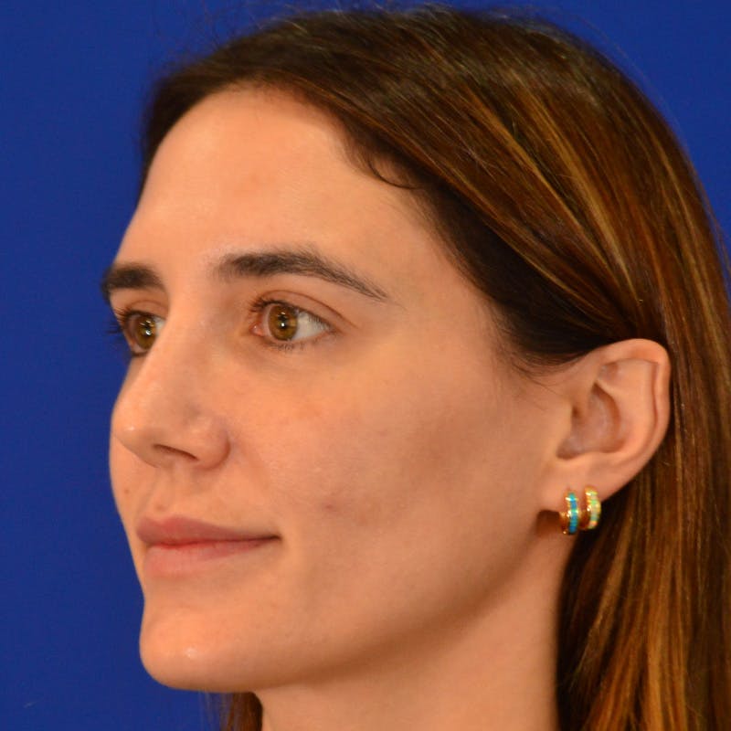 Female Rhinoplasty Before & After Gallery - Patient 414868 - Image 10