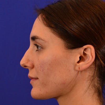 Dorsal Hump Before & After Gallery - Patient 220067 - Image 1