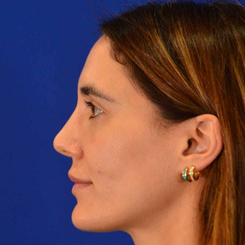 Female Rhinoplasty Before & After Gallery - Patient 414868 - Image 2