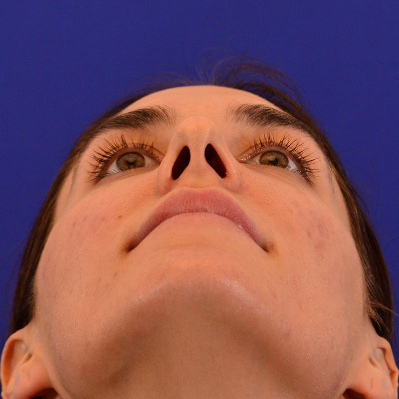 Female Rhinoplasty Before & After Gallery - Patient 414868 - Image 11