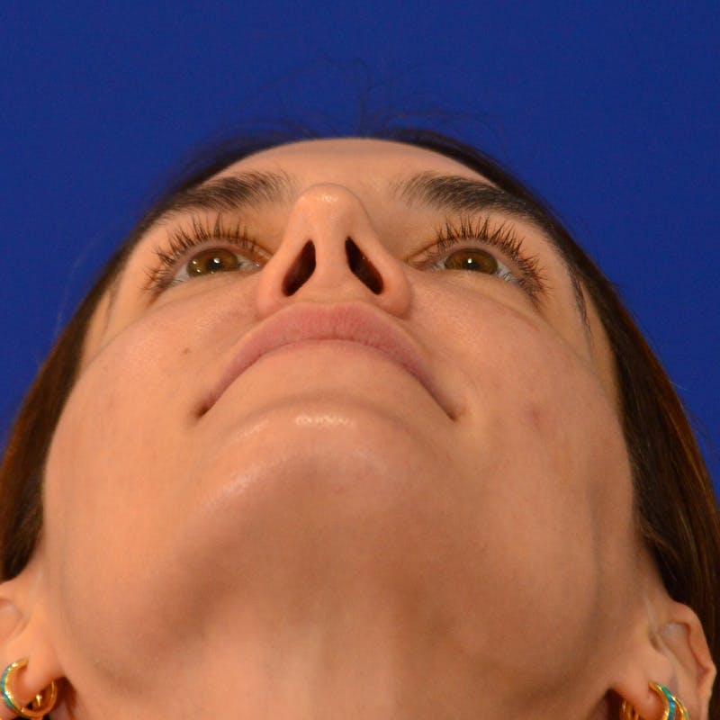 Female Rhinoplasty Before & After Gallery - Patient 414868 - Image 12