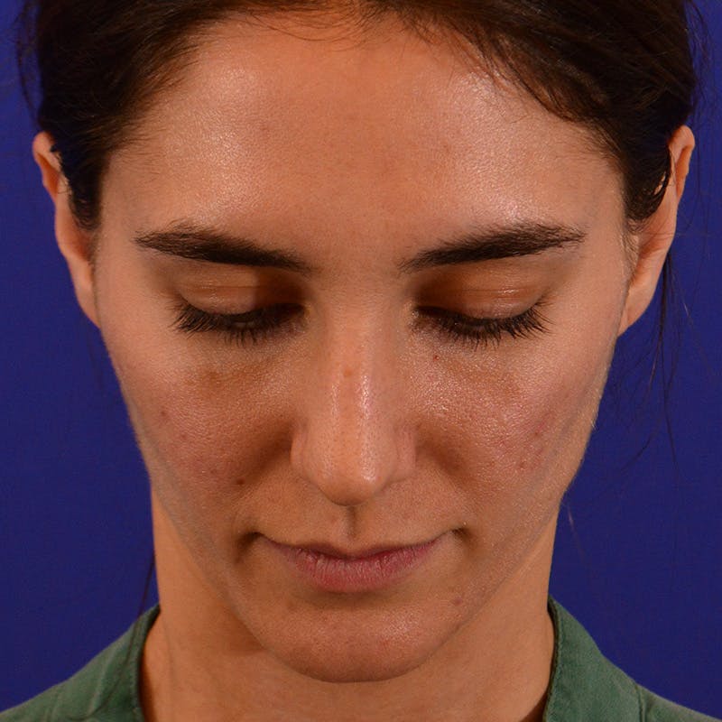 Female Rhinoplasty Before & After Gallery - Patient 414868 - Image 13