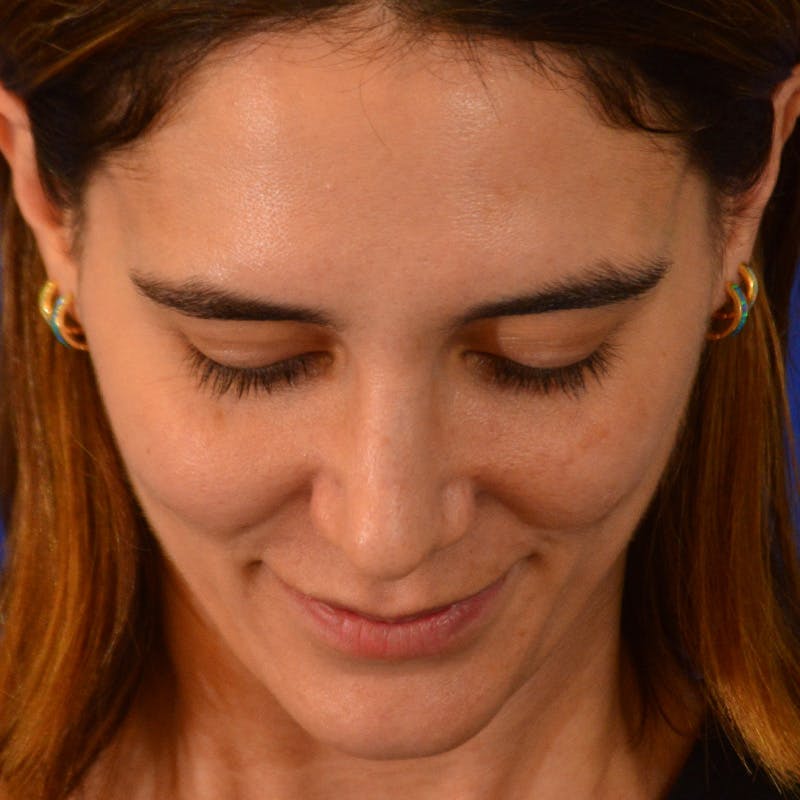 Female Rhinoplasty Before & After Gallery - Patient 414868 - Image 14