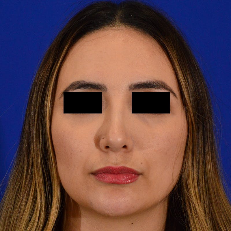 Female Rhinoplasty Before & After Gallery - Patient 210577 - Image 4
