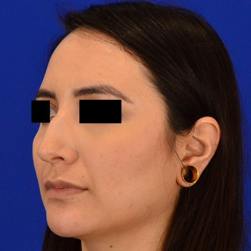 Female Rhinoplasty Before & After Gallery - Patient 210577 - Image 5
