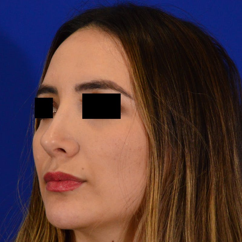 Female Rhinoplasty Before & After Gallery - Patient 210577 - Image 6