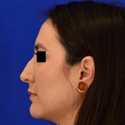 Dorsal Hump Before & After Gallery - Patient 277157 - Image 1