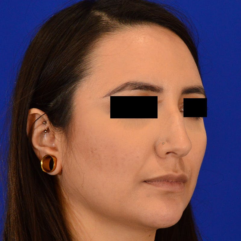 Female Rhinoplasty Before & After Gallery - Patient 210577 - Image 7