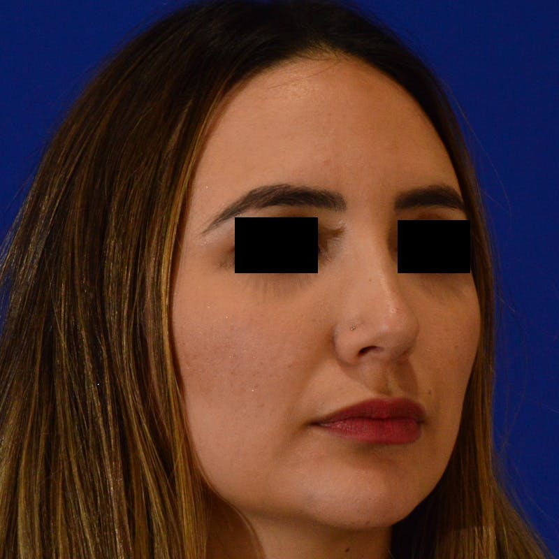 Female Rhinoplasty Before & After Gallery - Patient 210577 - Image 8