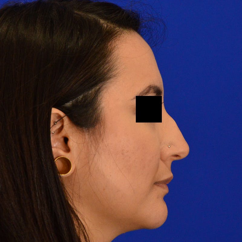 Female Rhinoplasty Before & After Gallery - Patient 210577 - Image 9