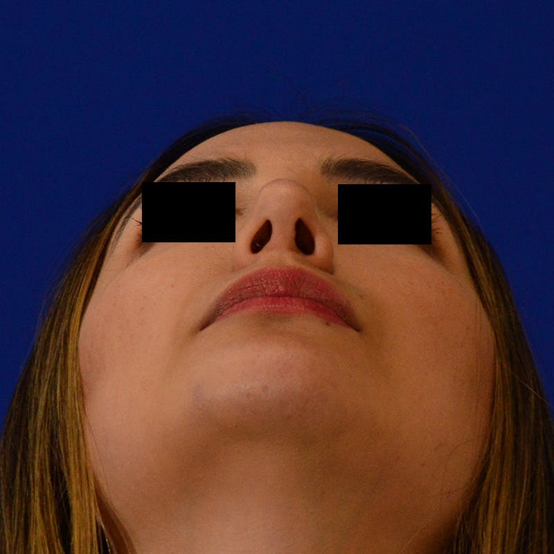 Female Rhinoplasty Before & After Gallery - Patient 210577 - Image 12