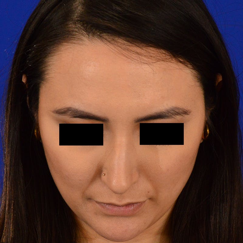 Female Rhinoplasty Before & After Gallery - Patient 210577 - Image 13