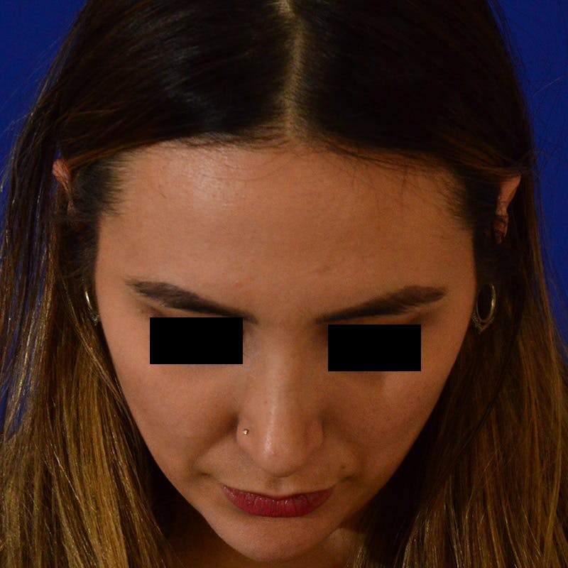Female Rhinoplasty Before & After Gallery - Patient 210577 - Image 14