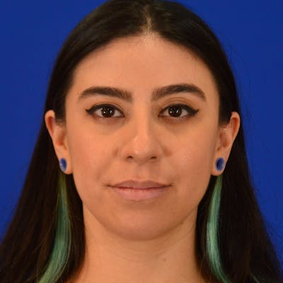 Chin Augmentation Before & After Gallery - Patient 140388 - Image 1