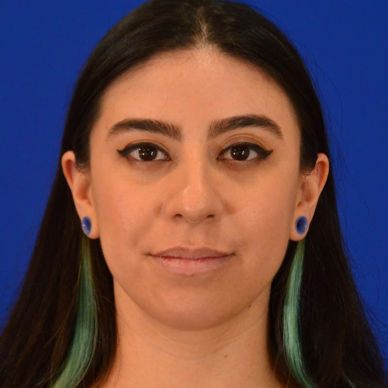 Female Rhinoplasty Before & After Gallery - Patient 649564 - Image 3