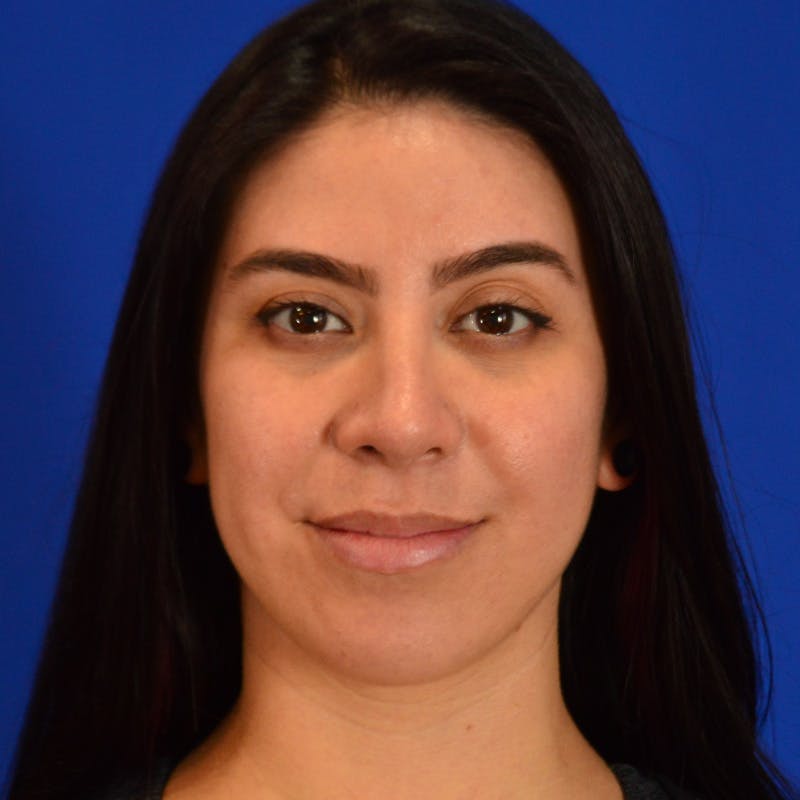 Female Rhinoplasty Before & After Gallery - Patient 649564 - Image 4