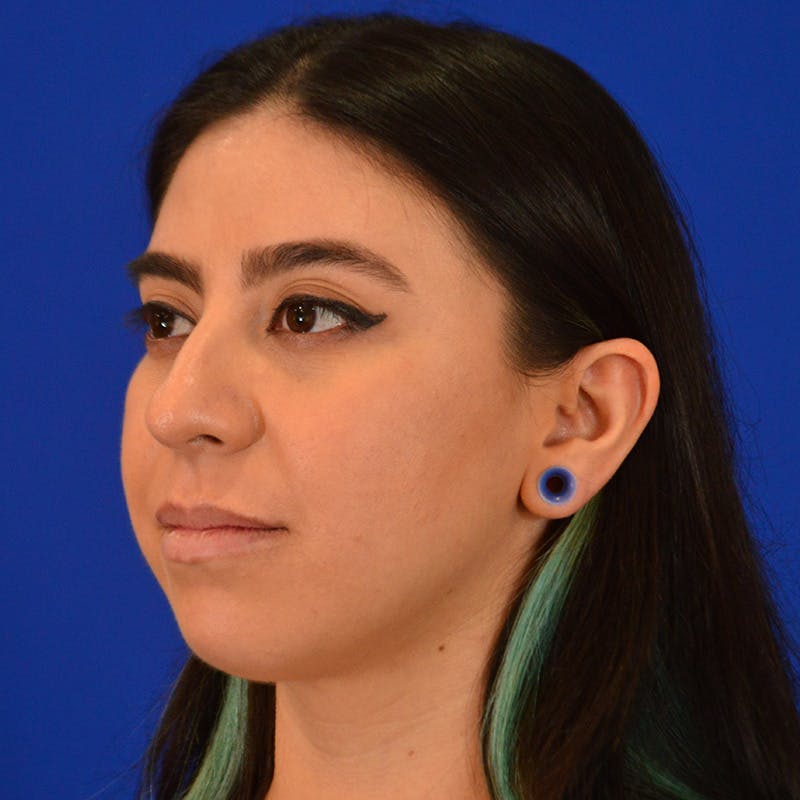 Female Rhinoplasty Before & After Gallery - Patient 649564 - Image 5