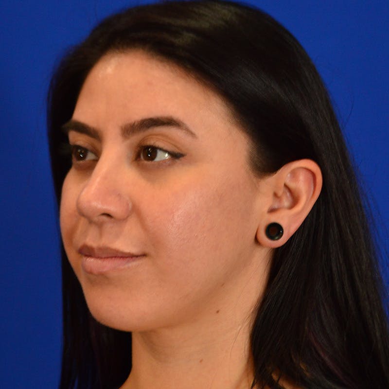 Female Rhinoplasty Before & After Gallery - Patient 649564 - Image 6