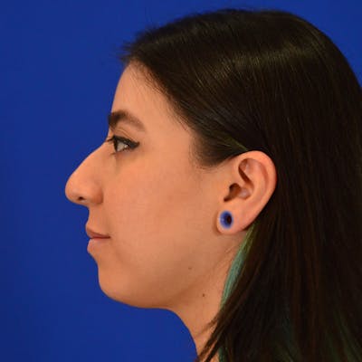 Dorsal Hump Before & After Gallery - Patient 206593 - Image 1