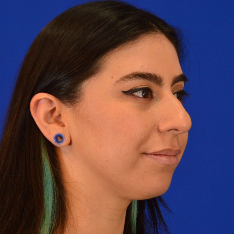 Female Rhinoplasty Before & After Gallery - Patient 649564 - Image 7