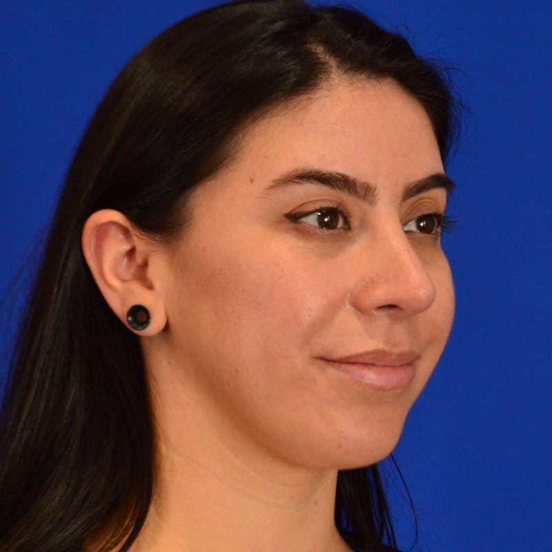Female Rhinoplasty Before & After Gallery - Patient 649564 - Image 8