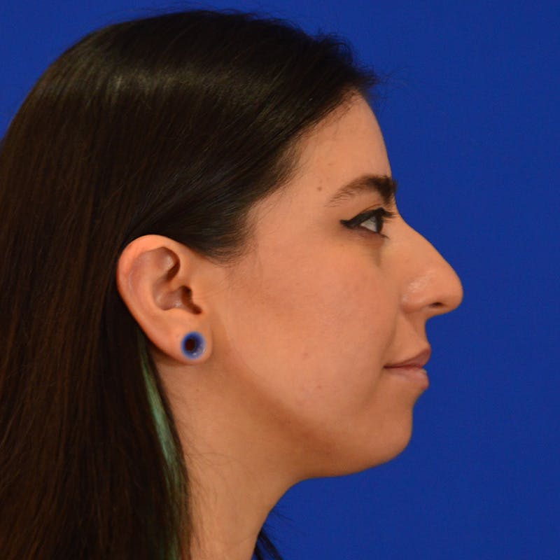 Female Rhinoplasty Before & After Gallery - Patient 649564 - Image 9