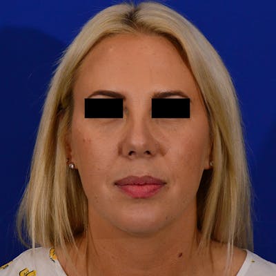Wide Nose Before & After Gallery - Patient 373265 - Image 2