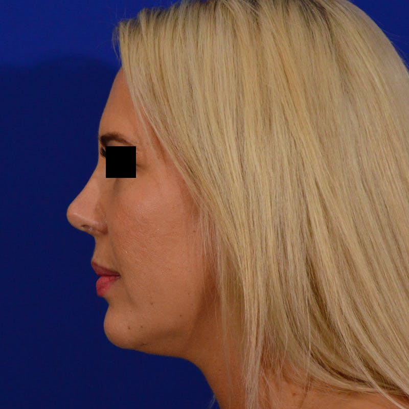Female Rhinoplasty Before & After Gallery - Patient 426519 - Image 2