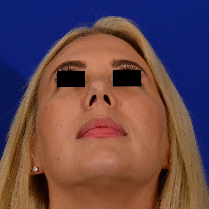 Female Rhinoplasty Before & After Gallery - Patient 426519 - Image 12
