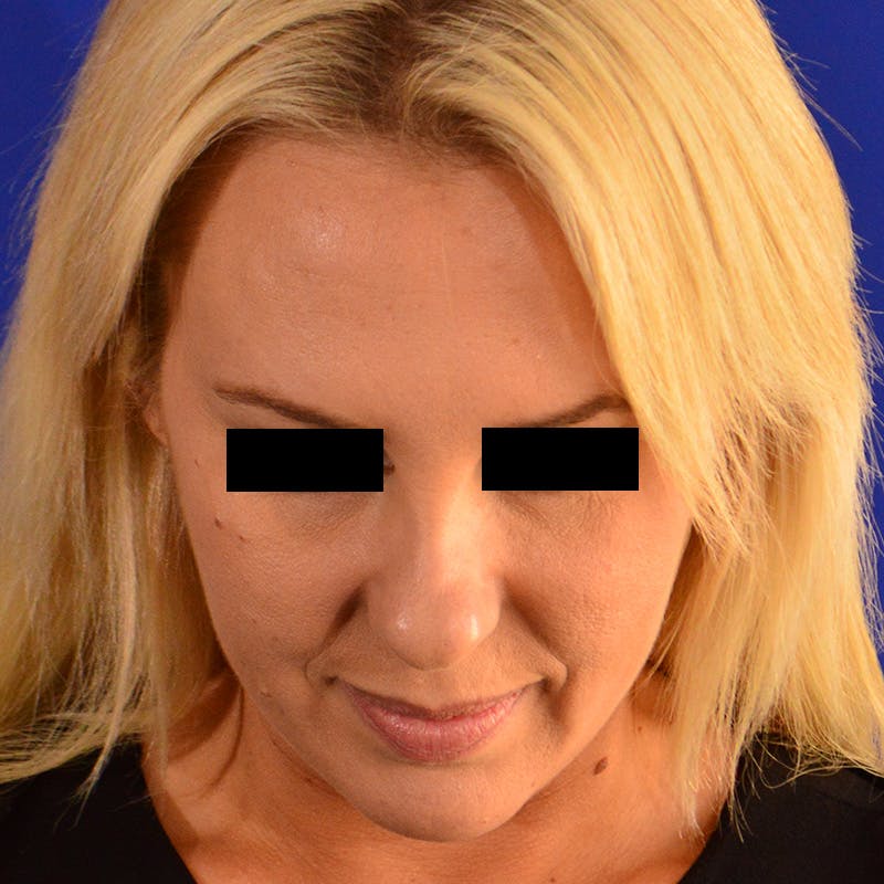 Female Rhinoplasty Before & After Gallery - Patient 426519 - Image 13