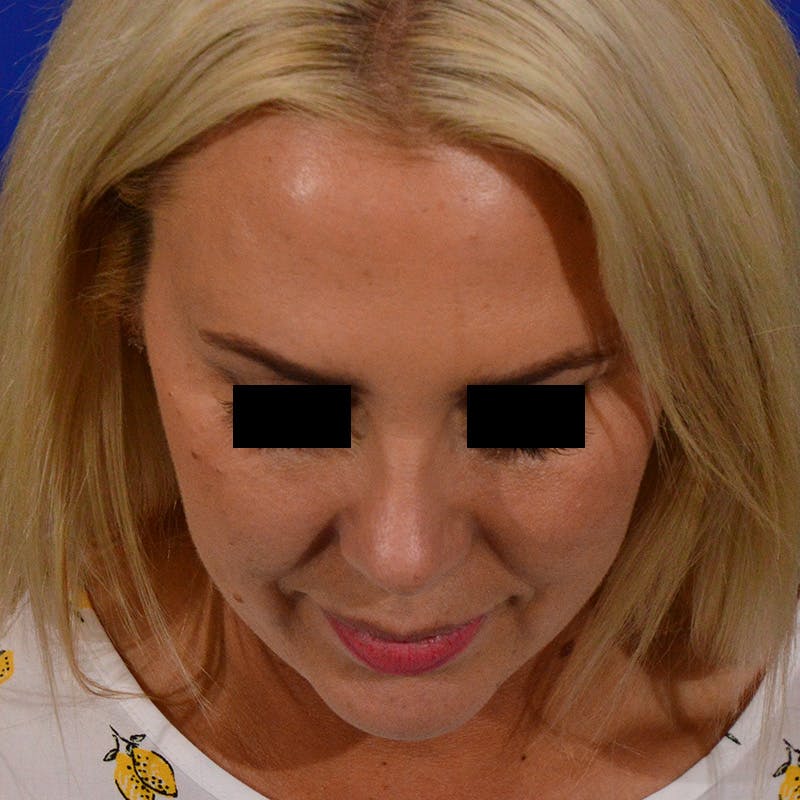 Female Rhinoplasty Before & After Gallery - Patient 426519 - Image 14
