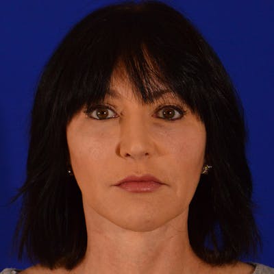 Crooked Nose Before & After Gallery - Patient 116522 - Image 2