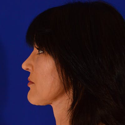 Female Rhinoplasty Before & After Gallery - Patient 268639 - Image 2