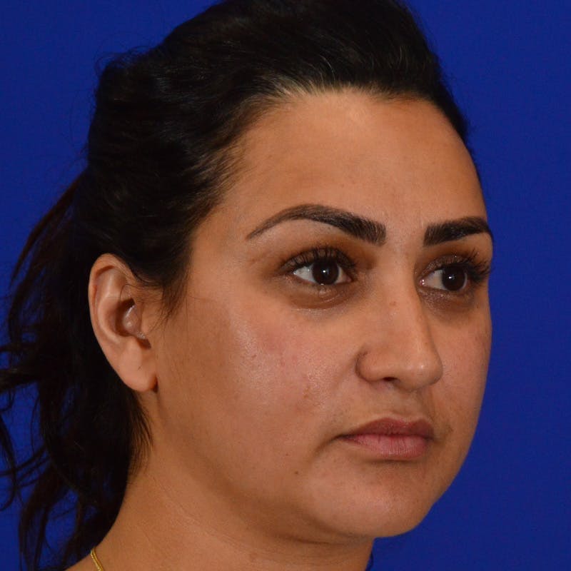 Ethnic Rhinoplasty Before & After Gallery - Patient 405459 - Image 4