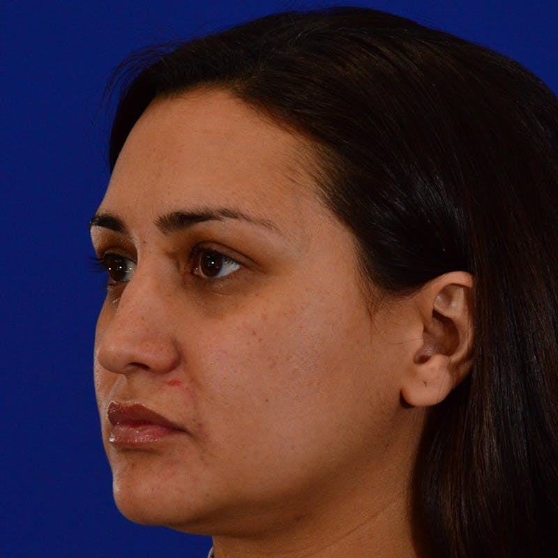 Ethnic Rhinoplasty Before & After Gallery - Patient 405459 - Image 7