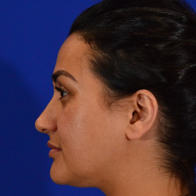 Ethnic Rhinoplasty Before & After Gallery - Patient 405459 - Image 10