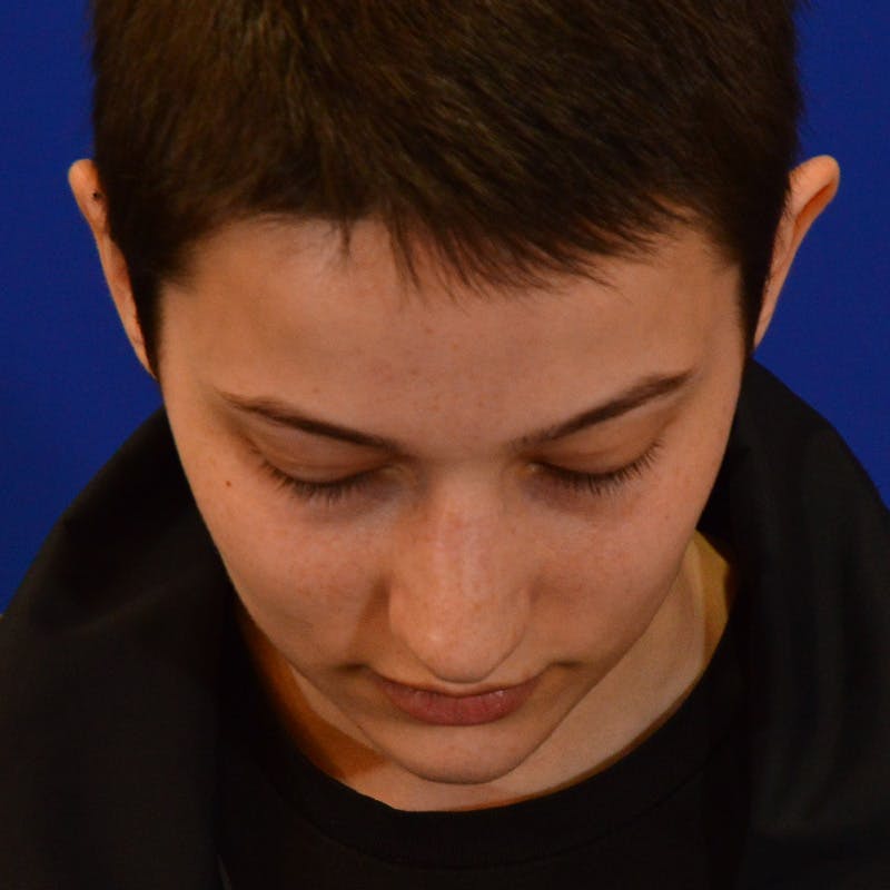 Revision Rhinoplasty Before & After Gallery - Patient 355453 - Image 13