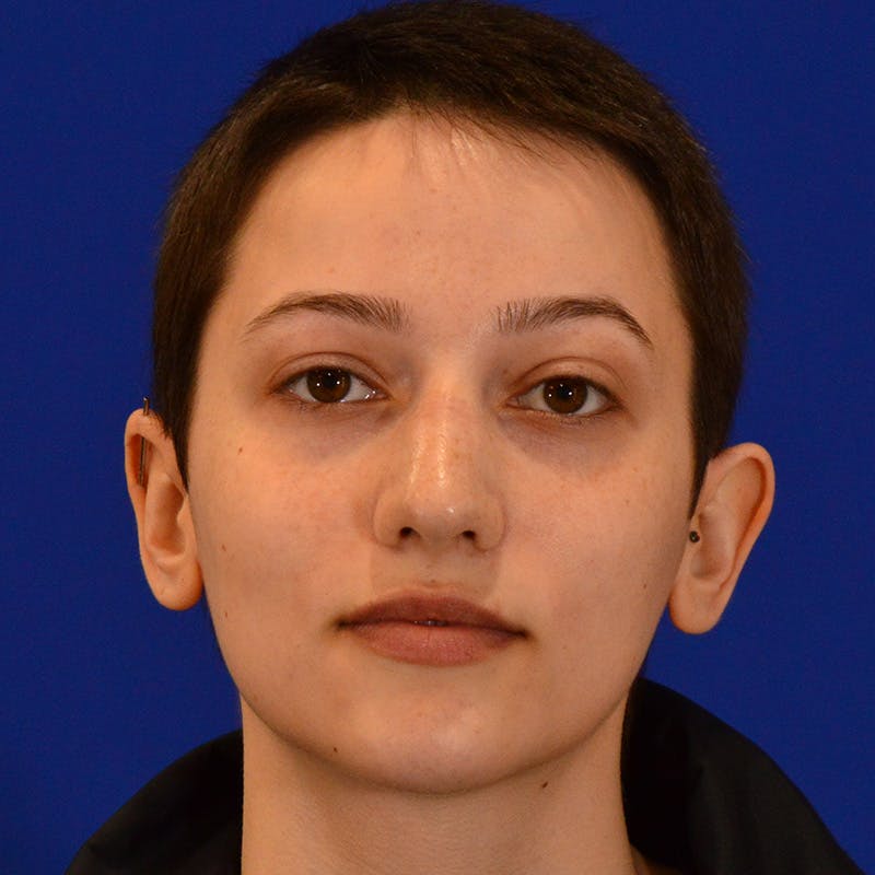 Revision Rhinoplasty Before & After Gallery - Patient 355453 - Image 5