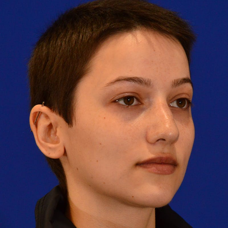 Revision Rhinoplasty Before & After Gallery - Patient 355453 - Image 3