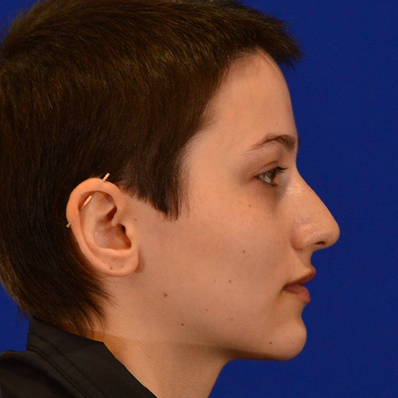 Revision Rhinoplasty Before & After Gallery - Patient 355453 - Image 1