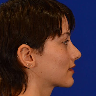 Revision Rhinoplasty Before & After Gallery - Patient 355453 - Image 2