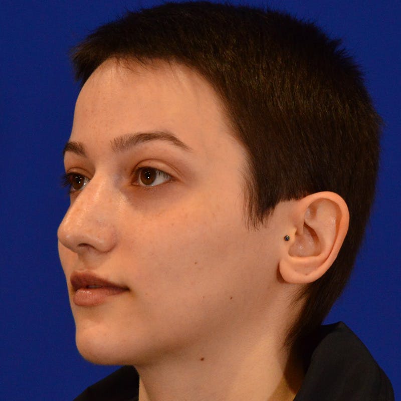 Revision Rhinoplasty Before & After Gallery - Patient 355453 - Image 7